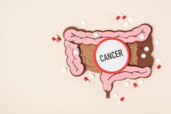 肠癌来临前有什么征兆？如厕后多看一眼