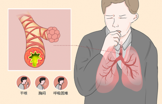 变异性哮喘是什么原因引起的 变异性哮喘的最佳治疗方法有哪些