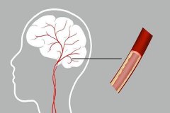 疱疹神经痛三叉神经痛千万不能“拖”