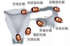 停经、腹痛、阴道流血？小心宫外孕