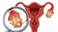 五成以上多囊患者存在肥胖体质！