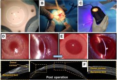 广东医生团队原创无缝线角膜移植技术