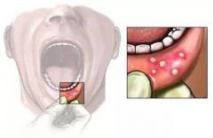 口腔溃疡三周还没好？小心口腔癌