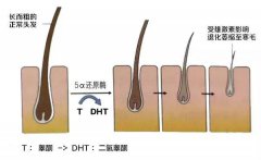 如何应对遗传性脱发？