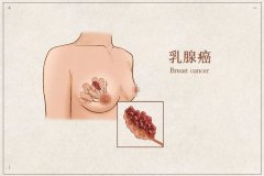 乳腺癌容易盯上哪些人？